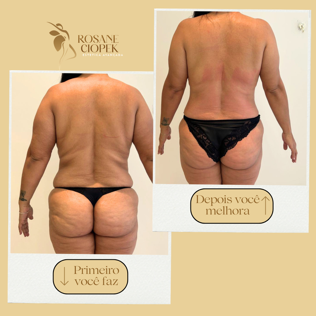 Resultado antes e depois do Método Ciopek 5