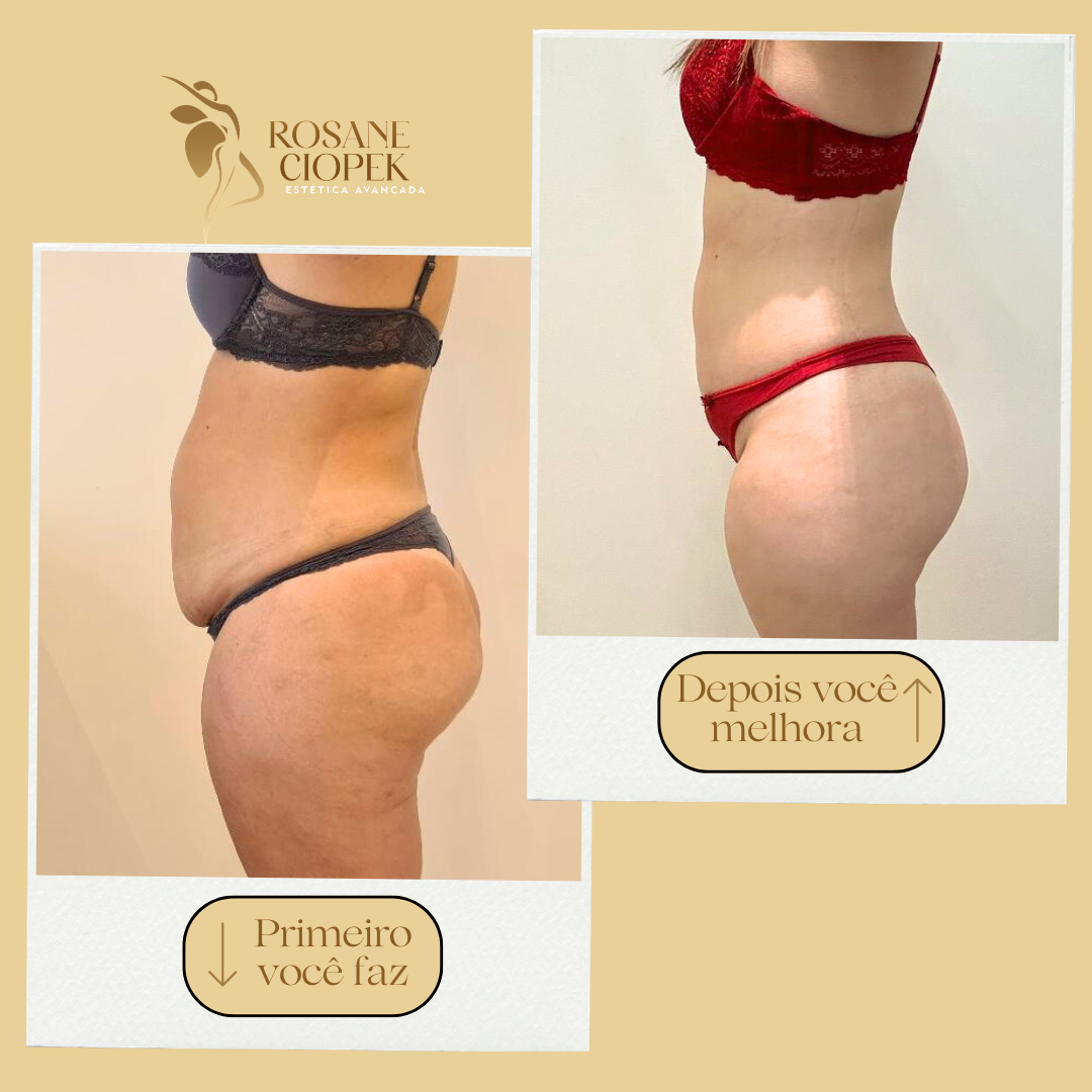 Resultado antes e depois do Método Ciopek 3
