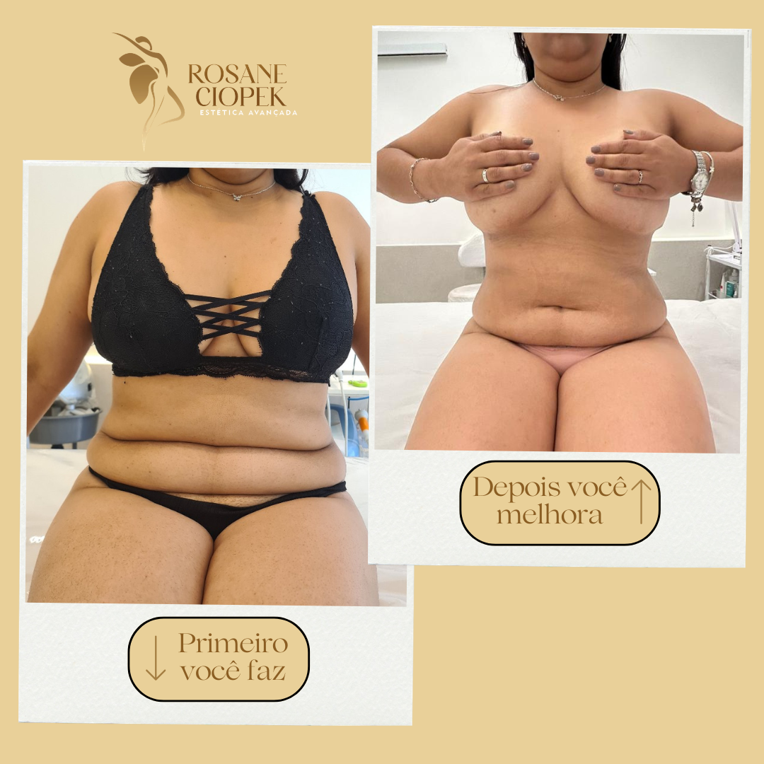 Resultado antes e depois do Método Ciopek 2