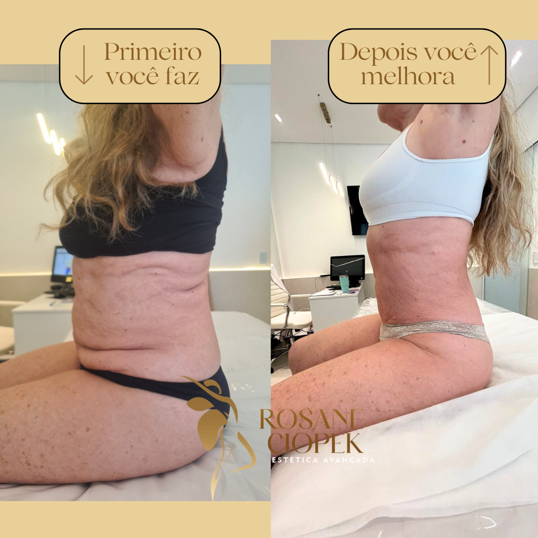 Resultado antes e depois do Método Ciopek 1